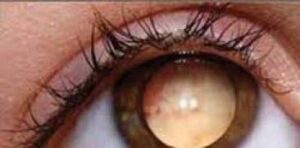 il retinoblastoma